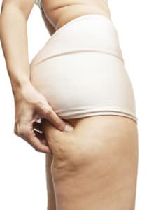 Reversing Cellulite