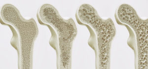 osteoporosis - thinning bones