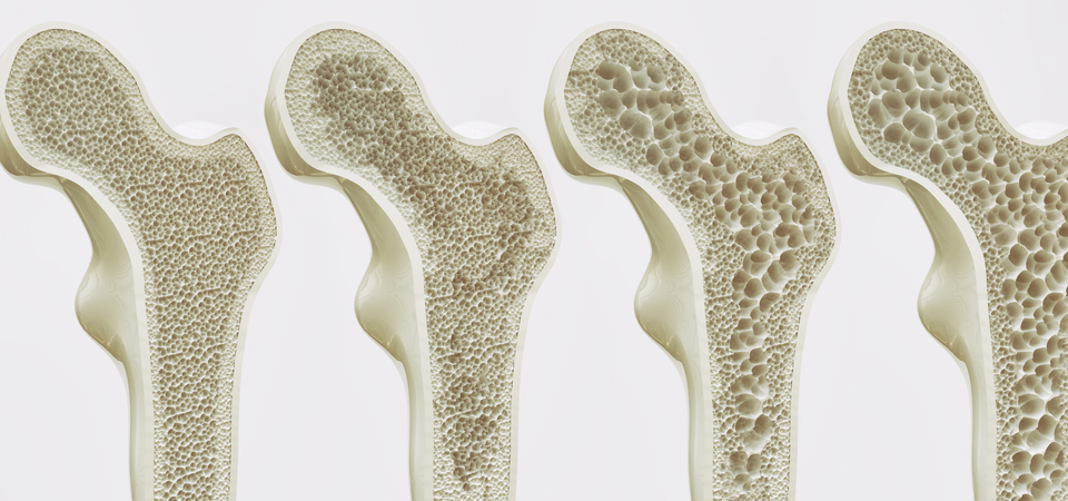 The GO-TO GUIDE for Reversing Osteoporosis