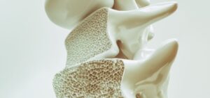 Bombshell Causes of Osteoporosis